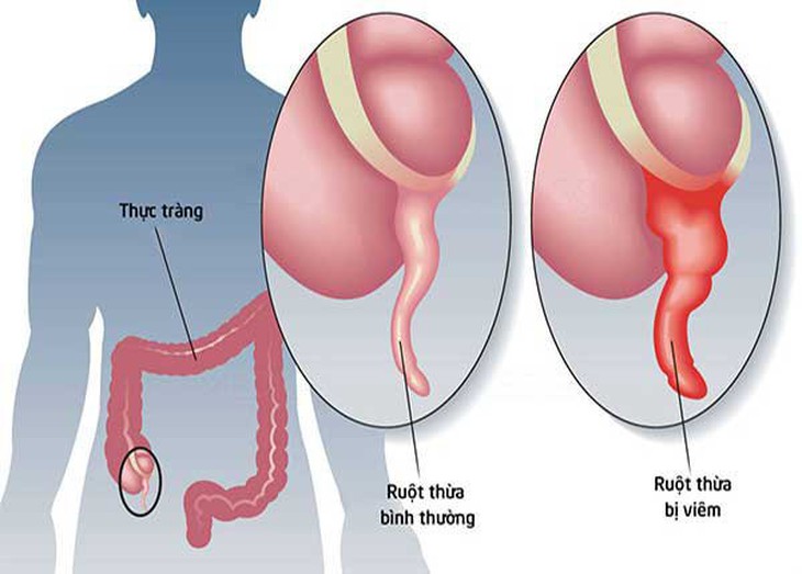 Viêm ruột thừa cấp